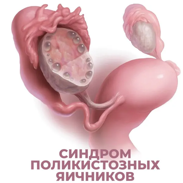Синдром поликистозных яичников (СПКЯ): симптомы, диагностика, беременность
