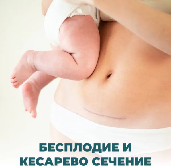 Влияет ли кесарево сечение на бесплодие?
